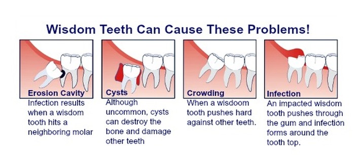 How To Impacted Tooth Removal